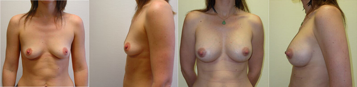 Увеличение груди :<br><span>Импланты или жировой аутотрансплантат (липомоделирование)</span>