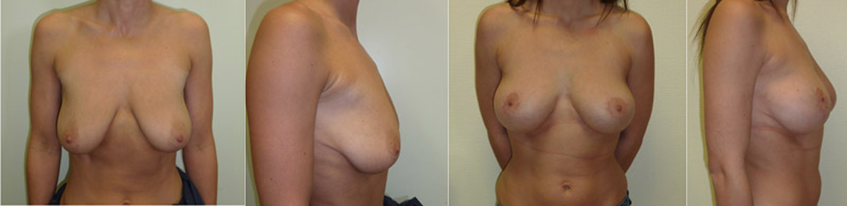 Маммопластика при опущении груди<br><span>( Птоз )</span>