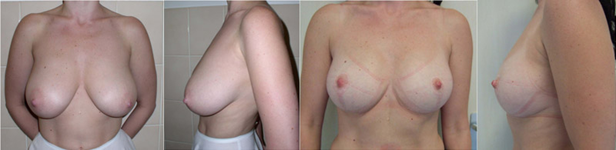 Breast reduction - Reduction mammoplasty