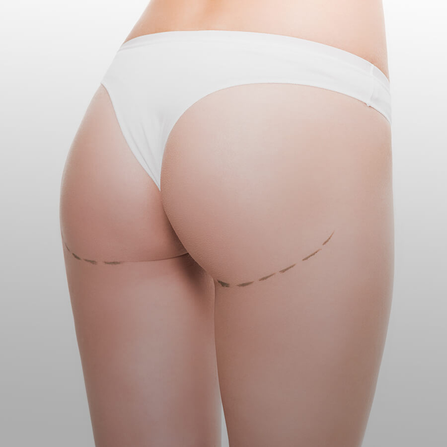 Buttock <br><span>augmentation</span>