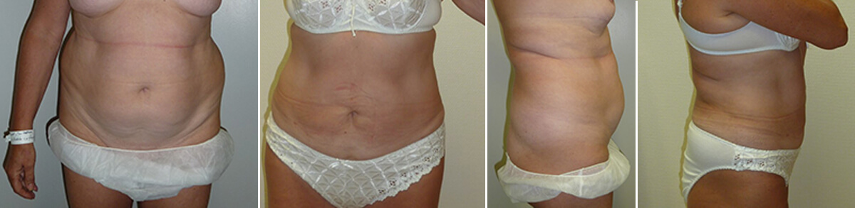 Abdominal liposuction