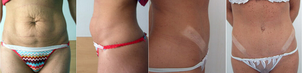 Abdominoplasty (“tummy tuck”)