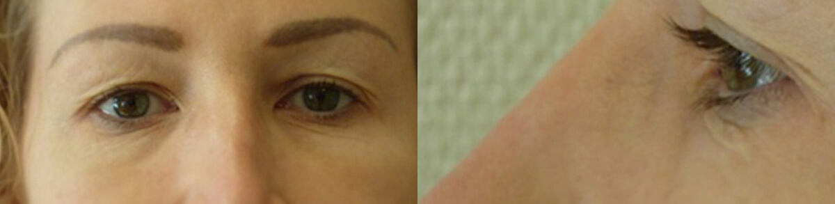 Blepharoplasty, eyelid surgery in Lyon and Geneva