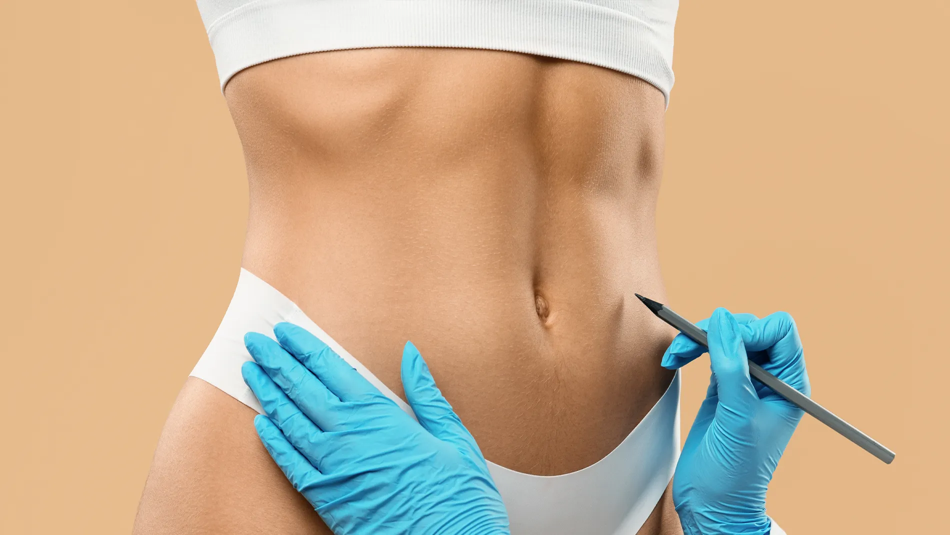 Illustration d&rsquo;une lipoaspiration abdominale avec marquage pr&eacute;op&eacute;ratoire de la silhouette et mise en valeur du remodelage du ventre