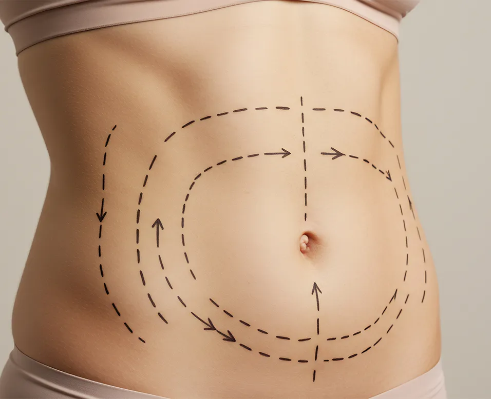 Illustration d&rsquo;un bodylift abdominal avec marquages chirurgicaux indiquant le repositionnement des tissus et le remodelage de la silhouette apr&egrave;s chirurgie esth&eacute;tique