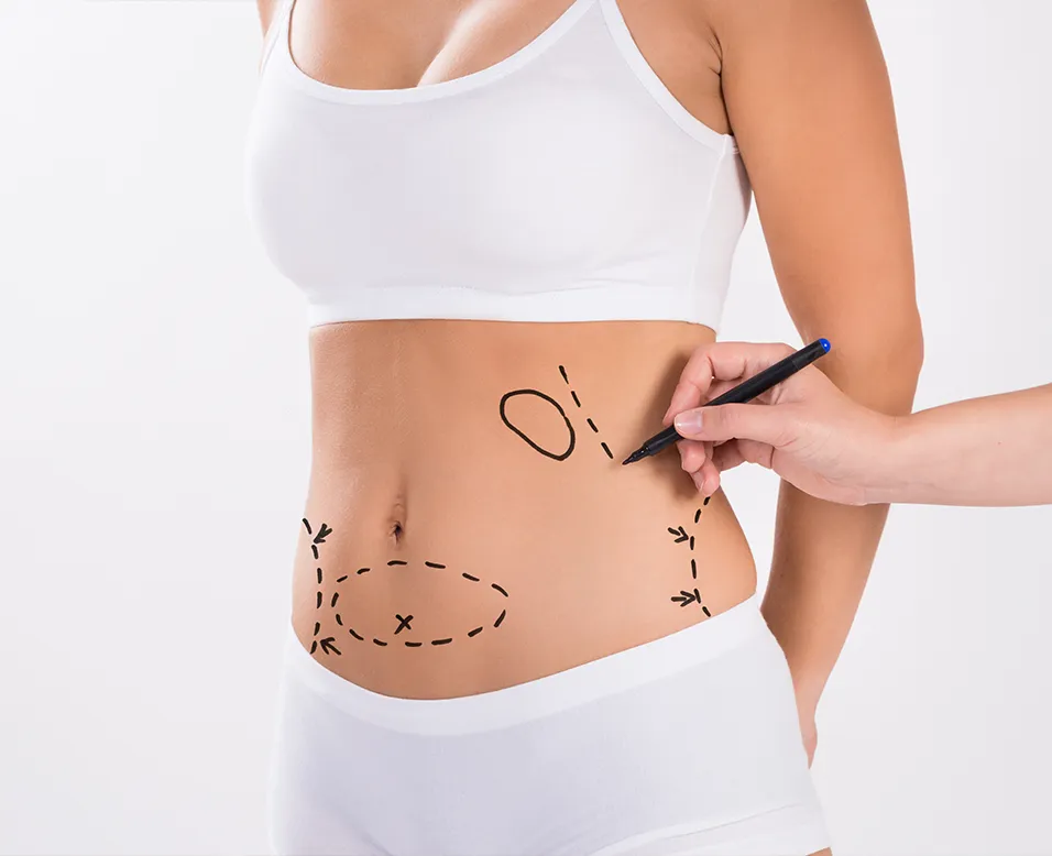 Illustration d&rsquo;une lipoaspiration avec marquages pr&eacute;op&eacute;ratoires sur l&rsquo;abdomen pour d&eacute;finir les zones de graisse &agrave; traiter et remodeler la silhouette