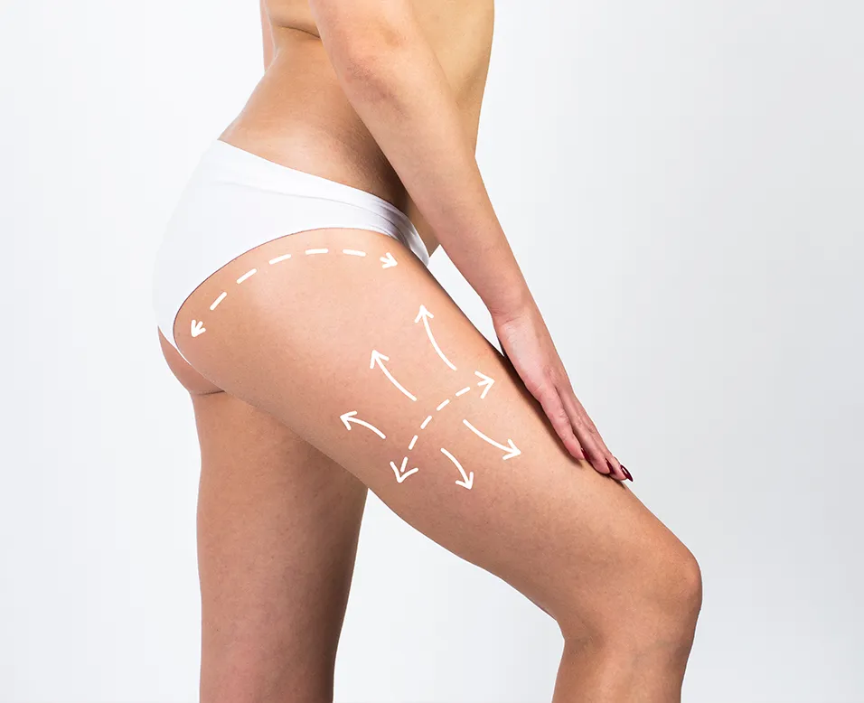 Illustration d&rsquo;une lipoaspiration des jambes ciblant les cuisses avec remodelage de la silhouette et r&eacute;duction des amas graisseux localis&eacute;s