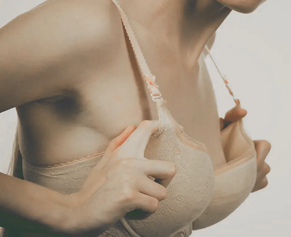 Femme en soutien-gorge illustrant le lipomodelage mammaire